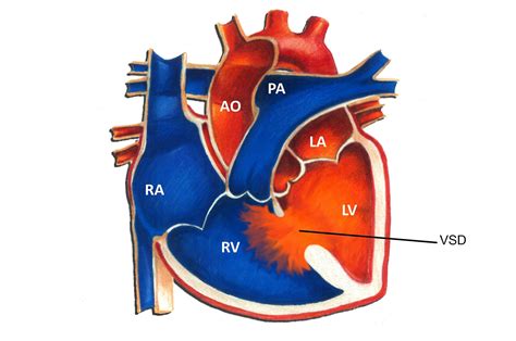 Ventricular Septal Defect Anatomy