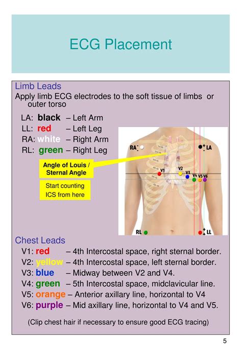 Ekg Placement