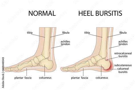 Calcaneal bursitis. Foot with normal heel and foot with Haglund's ...