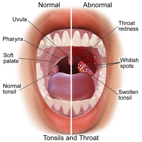 Strep Throat VS Sore Throat - Causes, Treatments, Preventions