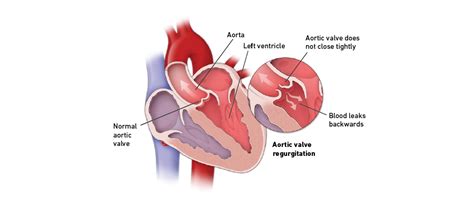 Aortic Valve Regurgitation | Temple Health