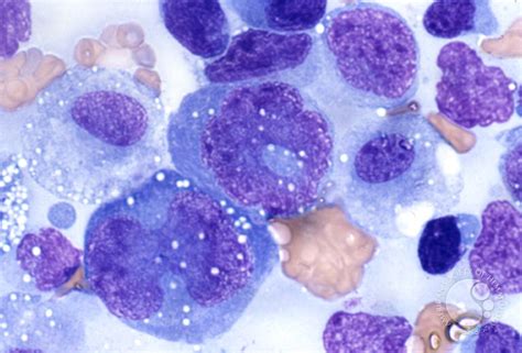 Anaplastic Large Cell Lymphoma - 5.