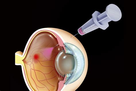 Treatment for Wet Age-Related Macular Degeneration