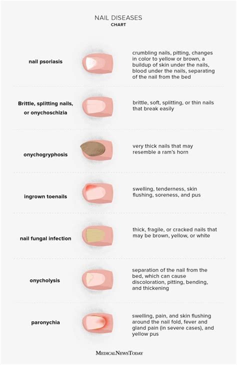 Nail diseases chart: Pictures, symptoms, and treatments Nail Diseases ...