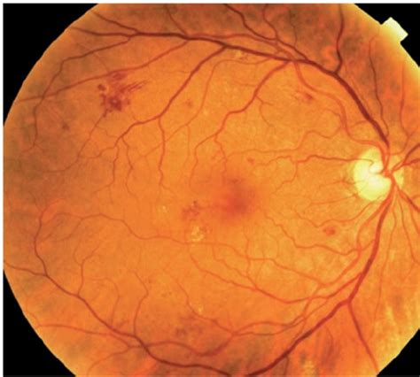 Mild non-proliferative diabetic retinopathy (NDPR) or background ...