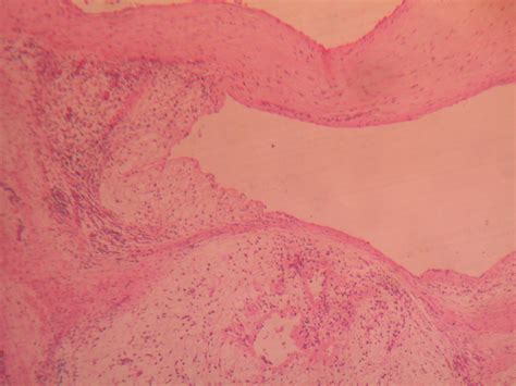 MENISCAL CYST – Histopathology.guru