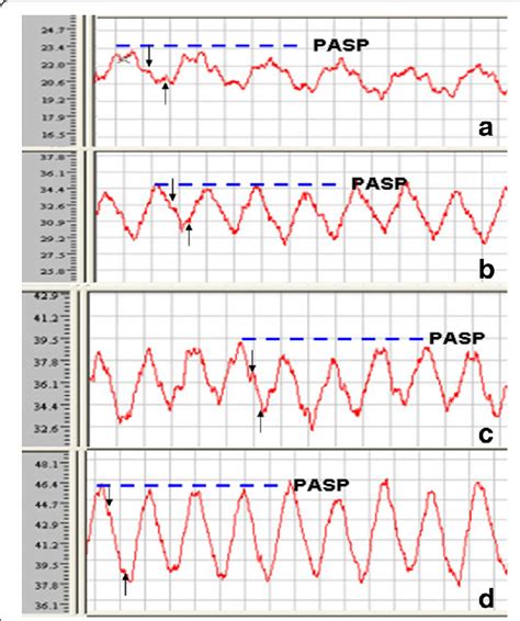 Pulmonary Artery Waveform Analysis