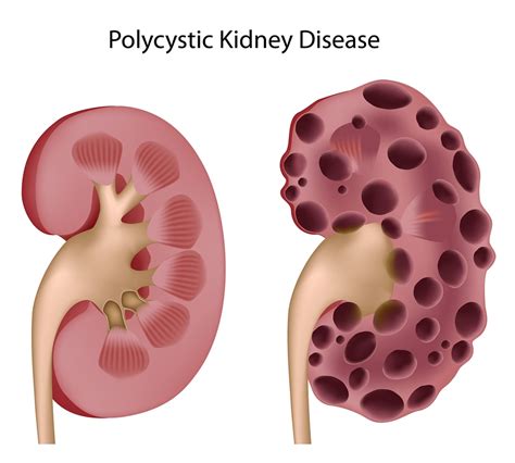 Kidney Pain - Causes, Location,Symptoms And Treatment