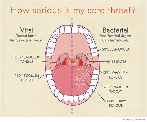 Home Remedies for Throat Pain: 22 Way How to Fix Throat