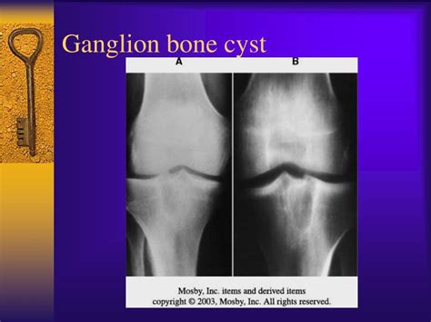 What are subchondral cysts: Hip Cysts | Subchondral Bone Cysts