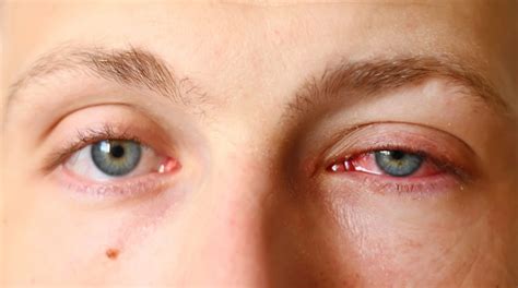 Pink Eye (conjunctivitis) - Symptoms and Treatment | Page 8 | Things Health