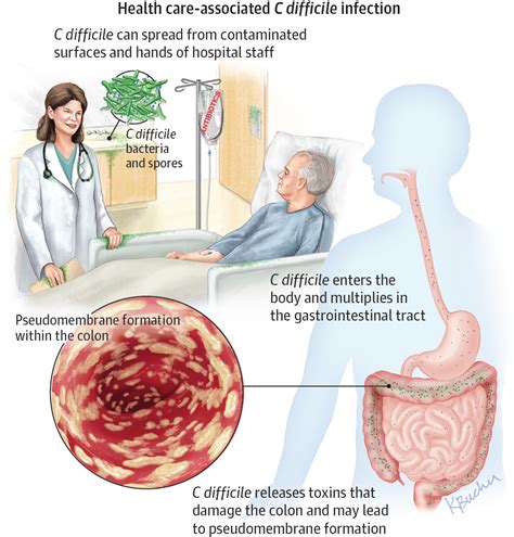 Fecal Transplant for Clostridioides difficile Effective in Practice ...