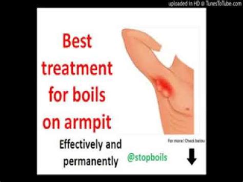 boils on armpit treatment, how to treat and prevent boils from coming ...