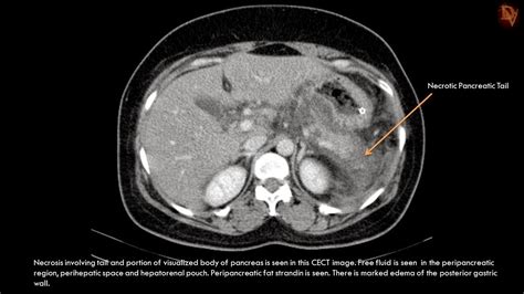 Ultimate Radiology : Acute Necrotizing Pancreatitis