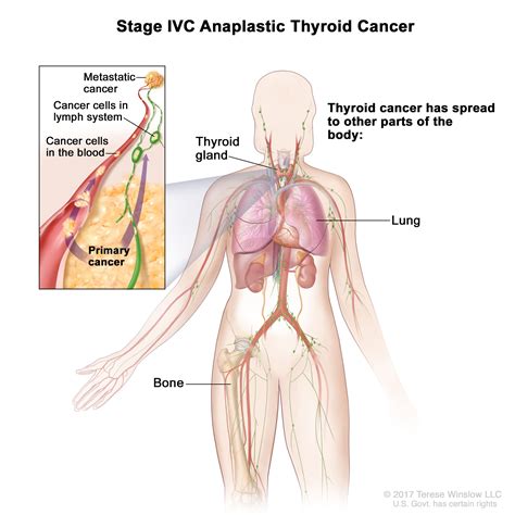 Thyroid Cancer Treatment (Adult) (PDQ®)–Health Professional Version - NCI