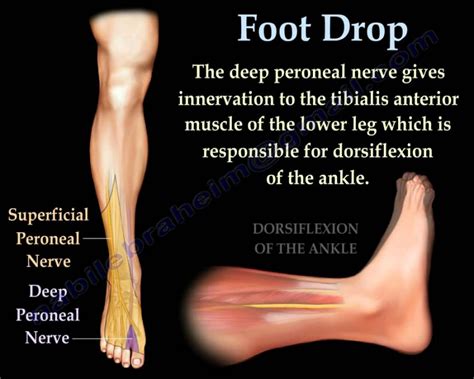 Foot Drop Treatment in Gurgaon | Foot Drop Physiotherapy Gurgaon