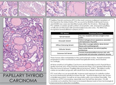 Papillary Thyroid Carcinoma