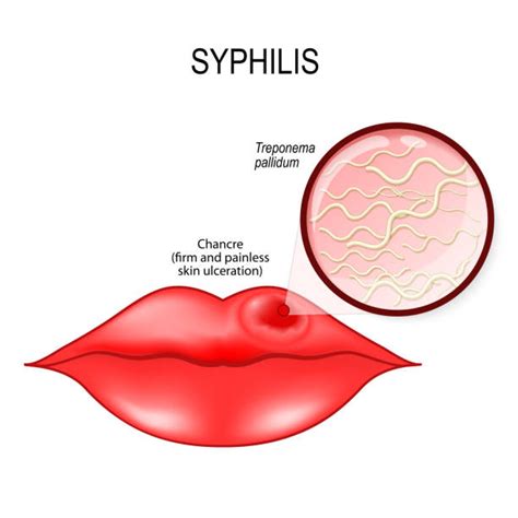 20+ Syphilis Chancre Stock Photos, Pictures & Royalty-Free Images - iStock