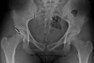 Examination of acetabular labral tear: a continued diagnostic challenge ...