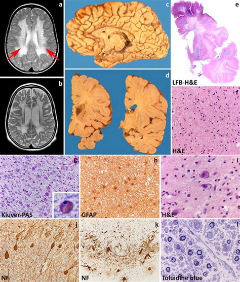 Metachromatic leukodystrophy. a T2-weighted axial image of a 7-year-old ...