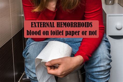 EXTERNAL HEMORRHOIDS: blood on toilet paper or not | Flickr