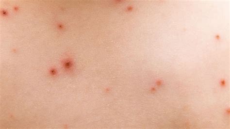 Nummular Eczema: 10 Symptoms Of Nummular Eczema