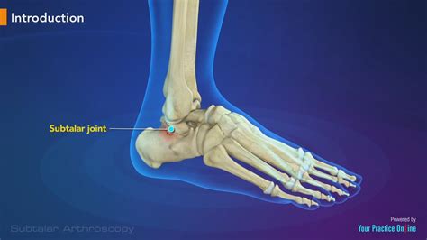 Subtalar Arthroscopy Video | Ankle Joint Surgery | Foot & Ankle