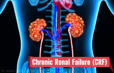 Chronic Renal Failure - Symptoms, Diagnosis, Complications, Treatment ...