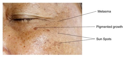 Why 99% of Skin Pigmentation Treatments FAIL