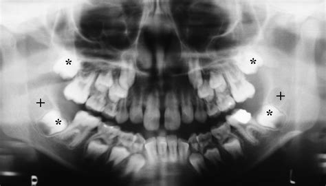 Dental Devices