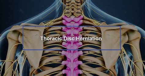 Thoracic Disc Herniation - Dr. Kevin Pauza, The Discseel® Procedure ...