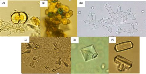 Triple Phosphate Crystals In Human Urine