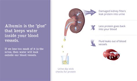 Proteinuria: What Causes Protein in Urine? - Gaytri Manek (Formerly ...