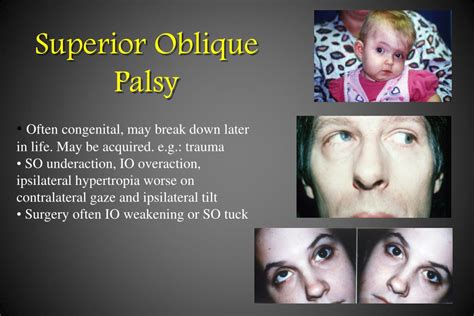 PPT - Paediatric Ophthalmology and Strabismus PowerPoint Presentation ...