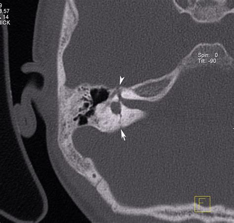 Radiodiagnosis - Imaging is Amazing-Interesting cases: Temporal bone ...