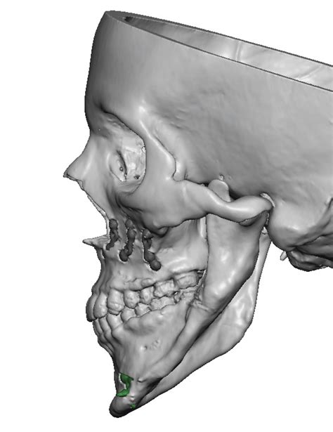 Plastic Surgery Case Study - Custom Left Cheek and Jaw Implants in ...