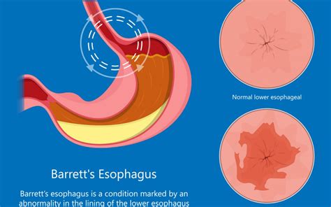 Understanding Barrett's Esophagus - Gastrointestinal Diseases, Inc ...