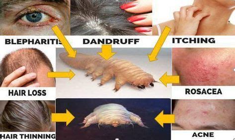 21 Demodex ideas | demodex, demodex mites, demodex treatment