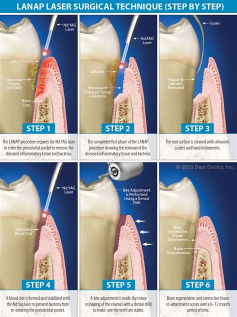 Periodontics (Gum Surgery) - North County Dental Specialties