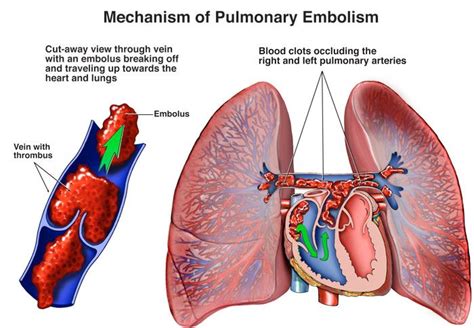 Pulmonary Embolism Treatment in New Jersey | Lung, Vascular Care