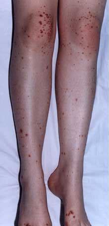 Vasculitis – edren.org