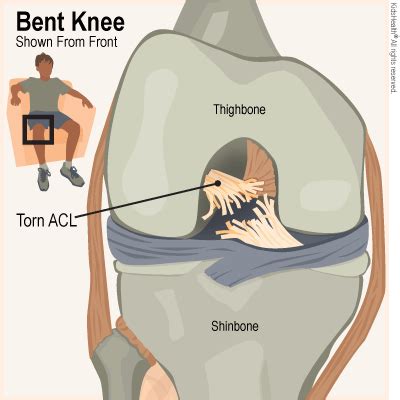 Anterior Cruciate Ligament (ACL) Tears (for Teens) | Nemours KidsHealth