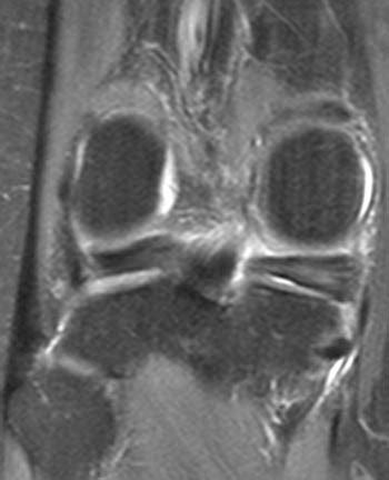 Posterior Root Tear of the Medial Meniscus | Radsource