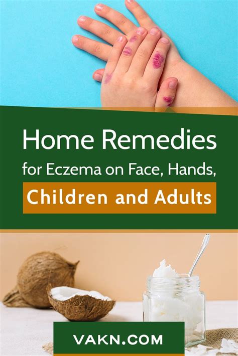 Best Home Remedies For Eczema Itch, Dryness On Face, Hands, And Legs In ...