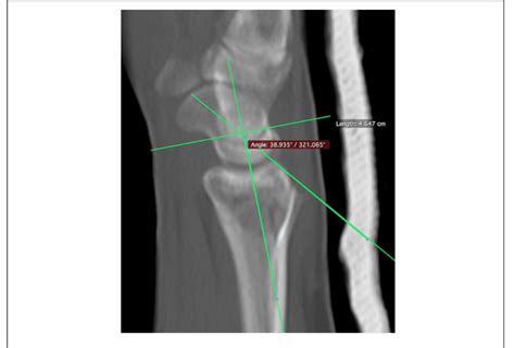 Measurement of the scapholunate angle in the sagittal plane. | Download ...