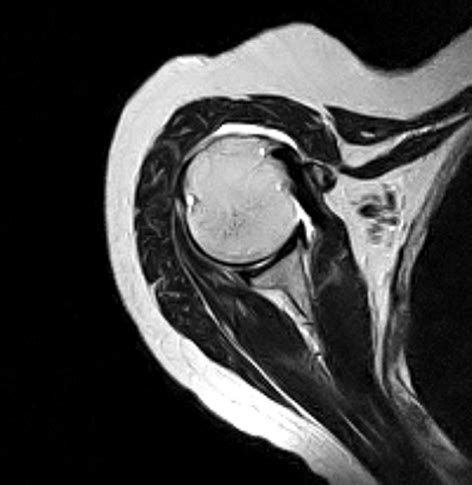 Shoulder MRI scan | Medserena Open MRI