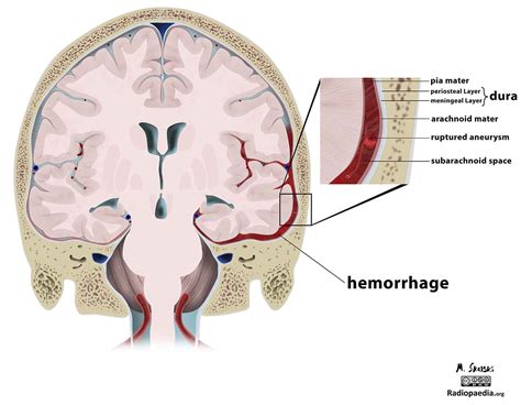 Traumatic Subarachnoid Hemorrhage