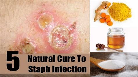 How To Cure A Staph Infection - Amountaffect17