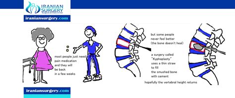 vertebral compression fractures treatment - Iranian Surgery