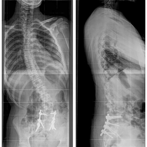 AP lumbar spine magnified to show rotation of L5 pedicles | Download ...